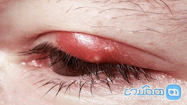 چرا گل مژه می زنیم؟