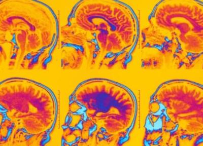 با اسکن مغز fMRI، شش نوع متمایز از افسردگی و اضطراب، شناسایی شد