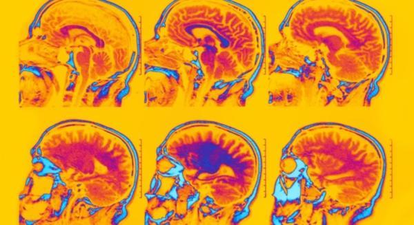 با اسکن مغز fMRI، شش نوع متمایز از افسردگی و اضطراب، شناسایی شد